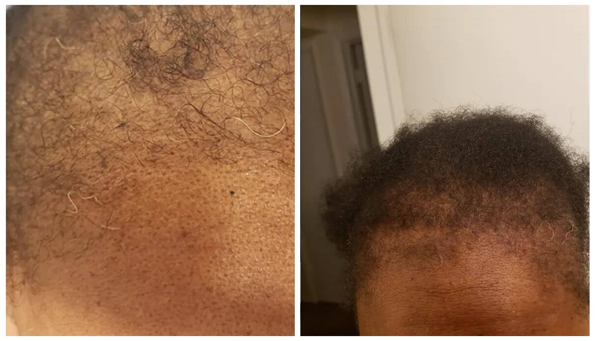 Customer edges before and after using Follicle Enhancer