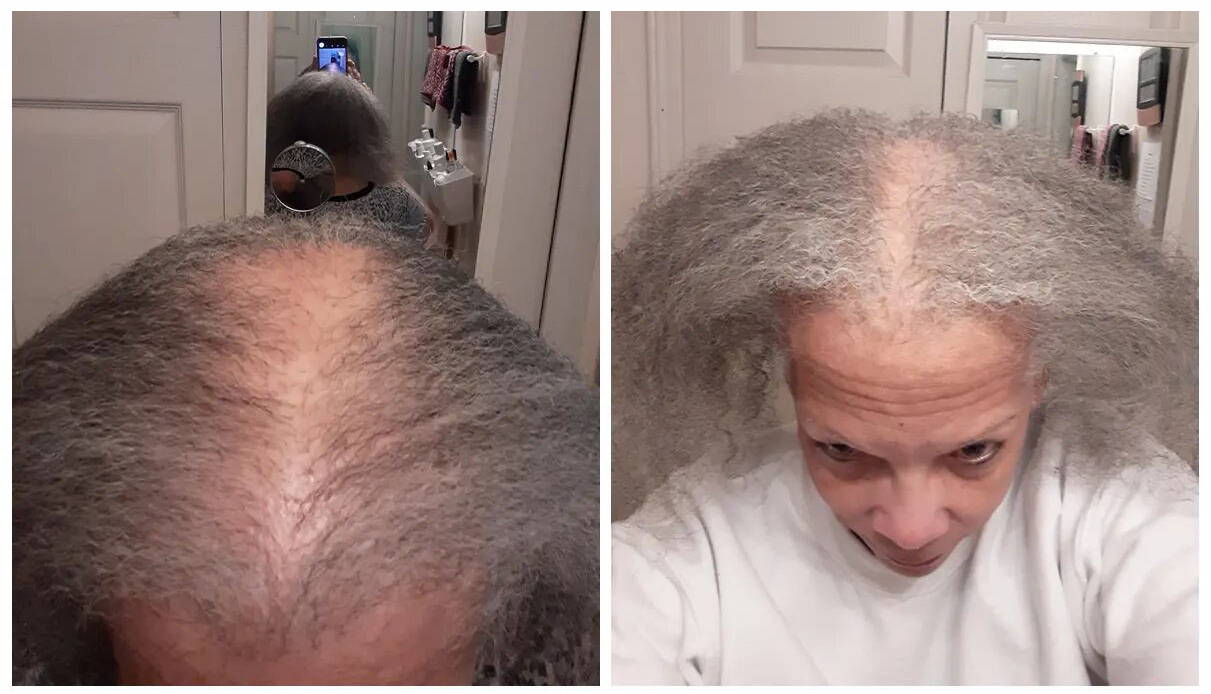 Customer edge regrowth before and after using Follicle Enhancer