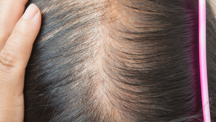 How to Rise Above Hereditary Hairline Thinning