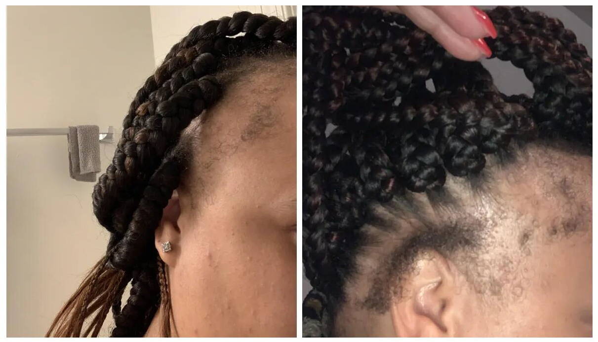 Customer hairline before and after using Follicle Enhancer